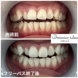 【セルフホワイトニングは歯を白くするだけではない】