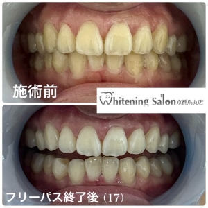 【歯茎の腫れ 痒み】