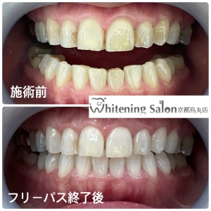 【ホワイトニングの相場チェック】